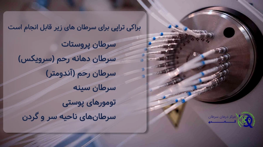 براکی تراپی برای درمان سرطان