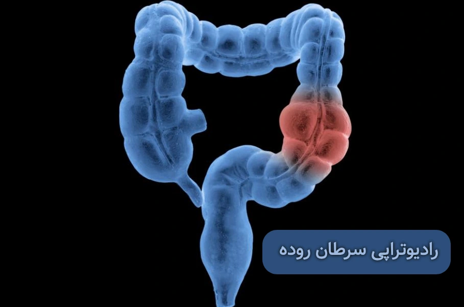 رادیوتراپی سرطان روده