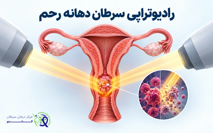 رادیوتراپی سرطان دهانه رحم